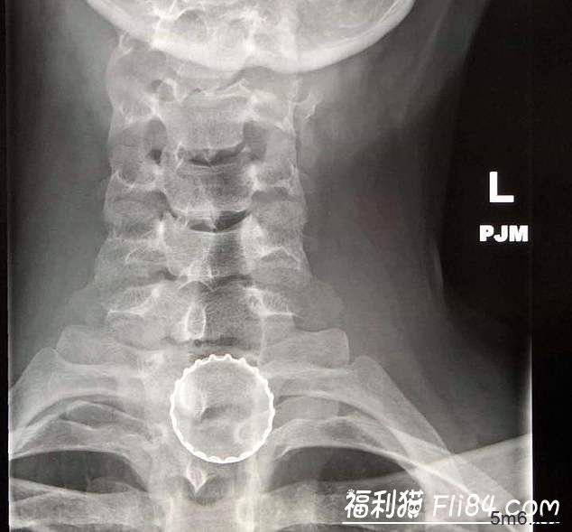 2019年《老美往某穴插入的异物种类》统计 人们到底是多爱往洞里塞圣诞节装饰物啊