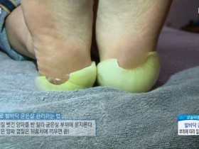 【蜗牛扑克】硬脚皮怎么去掉 韩国节目推荐用洋葱去脚皮超可爱