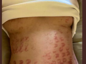 【EV扑克】除毛搞得一身伤!宝生リリー(宝生莉莉)恐生涯终结!【EV扑克官网】