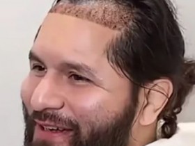 从八角笼到手术台:UFC名将豪尔赫·马斯维达尔赴土耳其植发,大发体育助力你的致富之路!